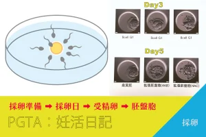 PGTAで体外受精した時の採卵の記録